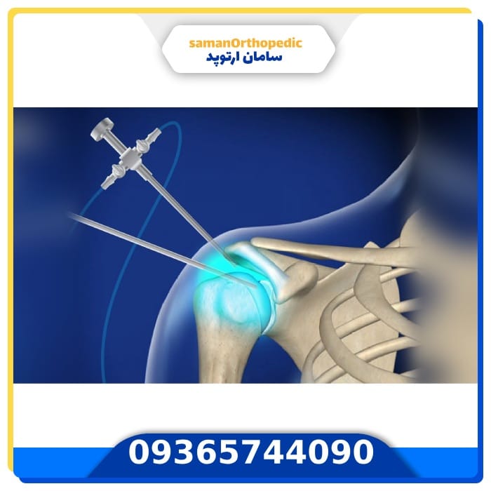 عمل جراحی مفصل شانه
