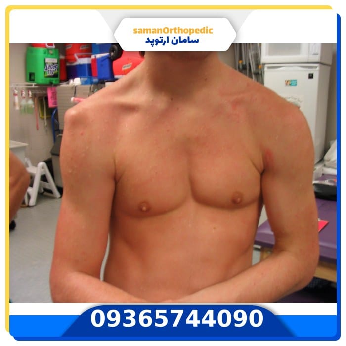 عمل جراحی مفصل شانه