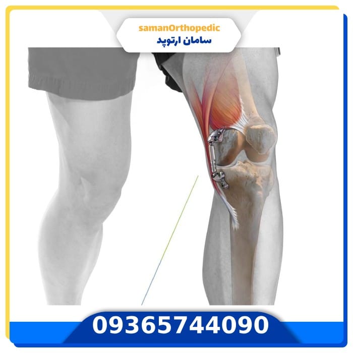 عمل جراحی تعویض مفصل زانو