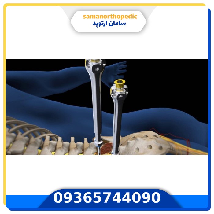 عمل جراحی دیسک کمر