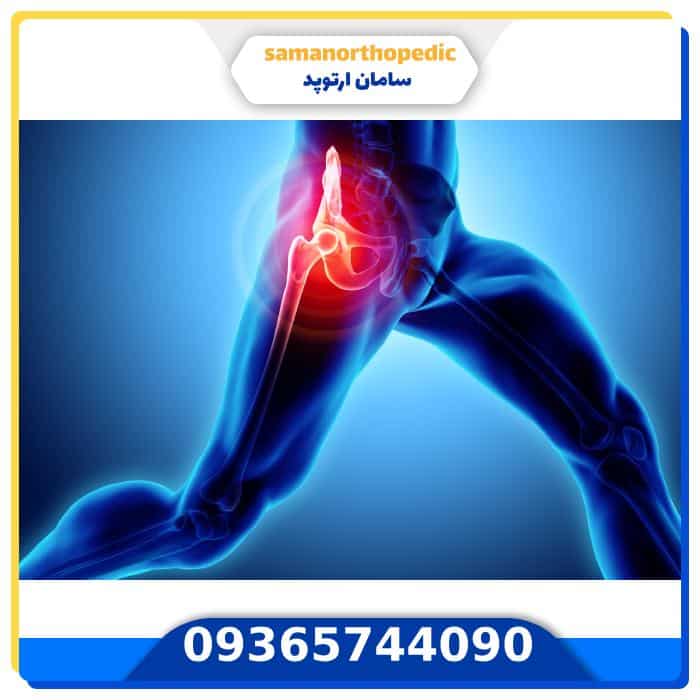 عمل جراحی تعویض مفصل لگن