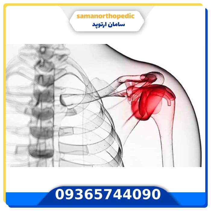 عمل جراحی مفصل شانه