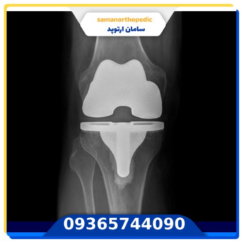 پروتز زانو چیست
