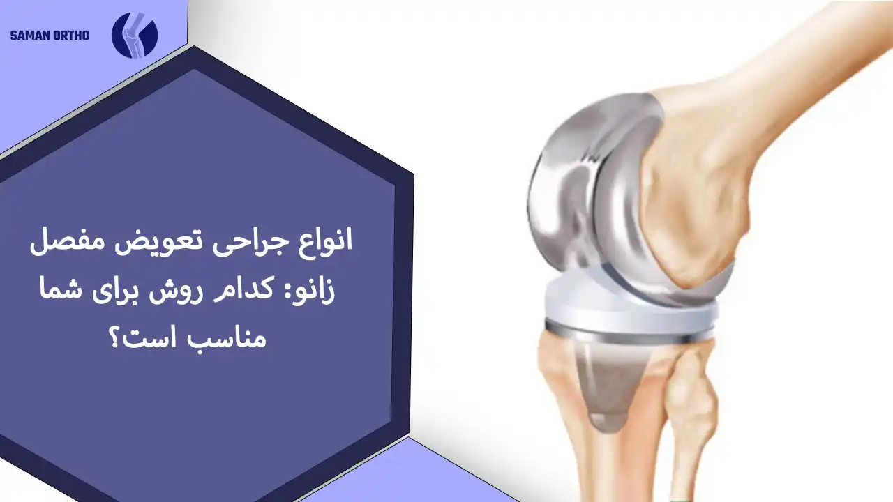 عمل جراحی تعویض مفصل زانو | آرتروپلاستی زانو آرتروپلاستی زانو یا همان تعویض مفصل زانو توتال
