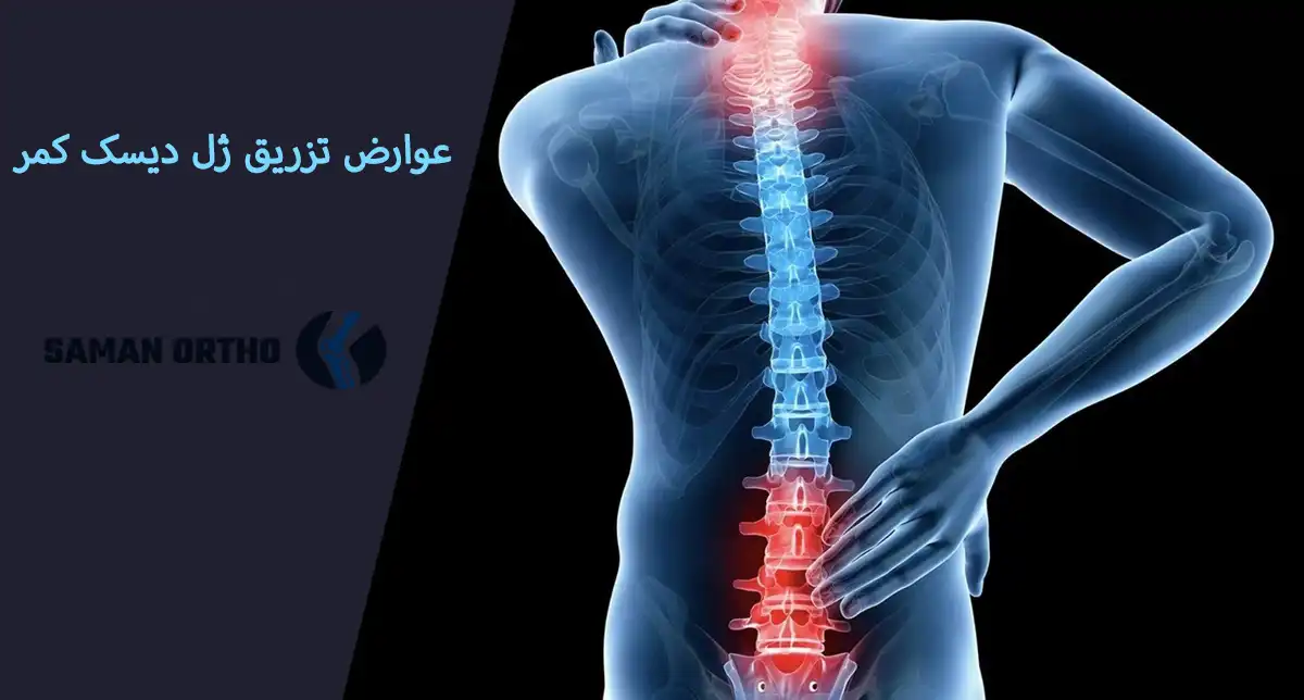 تزریق ژل به ستون فقرات تزریق ژل به ستون فقرات