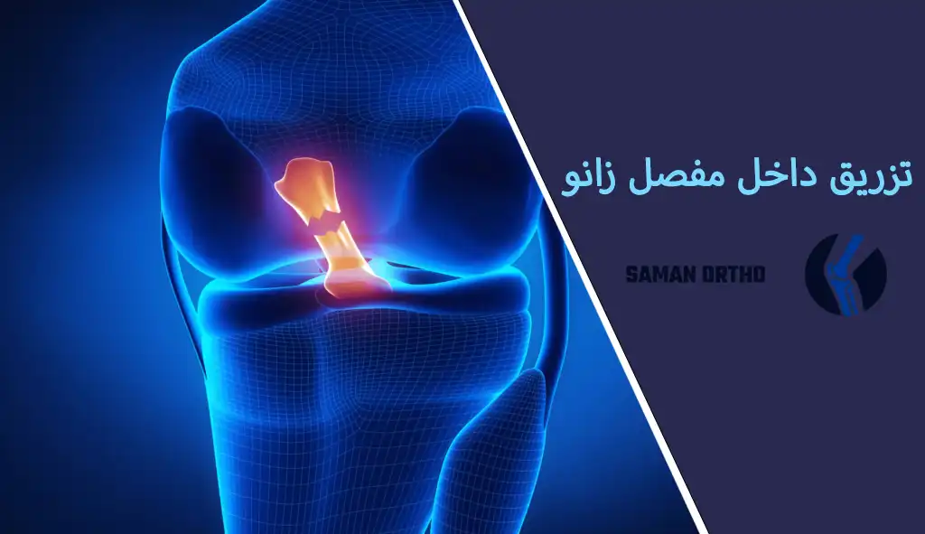 فیلم تزریق داخل مفصل زانو تزریق داخل مفصل زانو