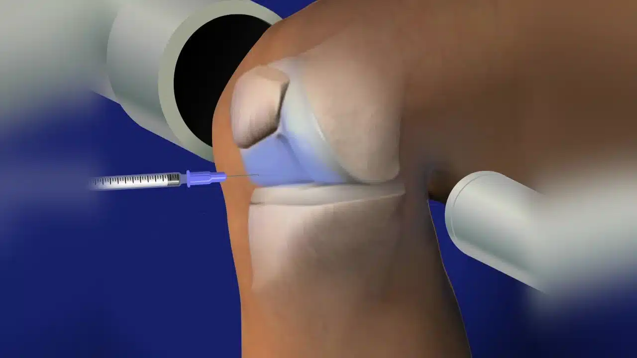 تزریق ژل به زانو تزریق داخل مفصل زانو