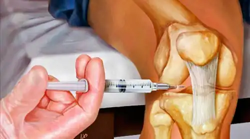 هزینه تزریق داخل مفصل زانو هزینه ترزیق داخل مفصل زانو