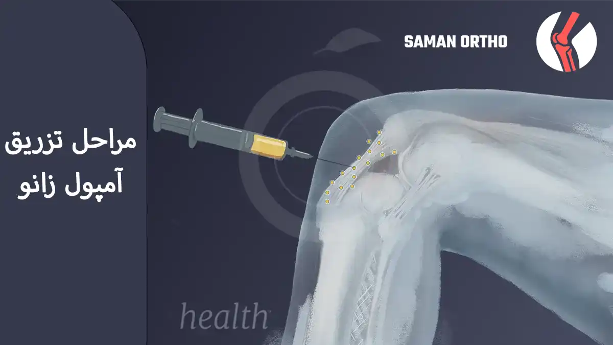 کیا بعد تزریق آمپول زانو بهبود یافتند؟ کیا بعد تزریق آمپول زانو خوب شدن