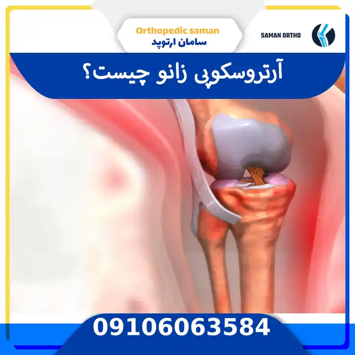 آرتروسکوپی زانو