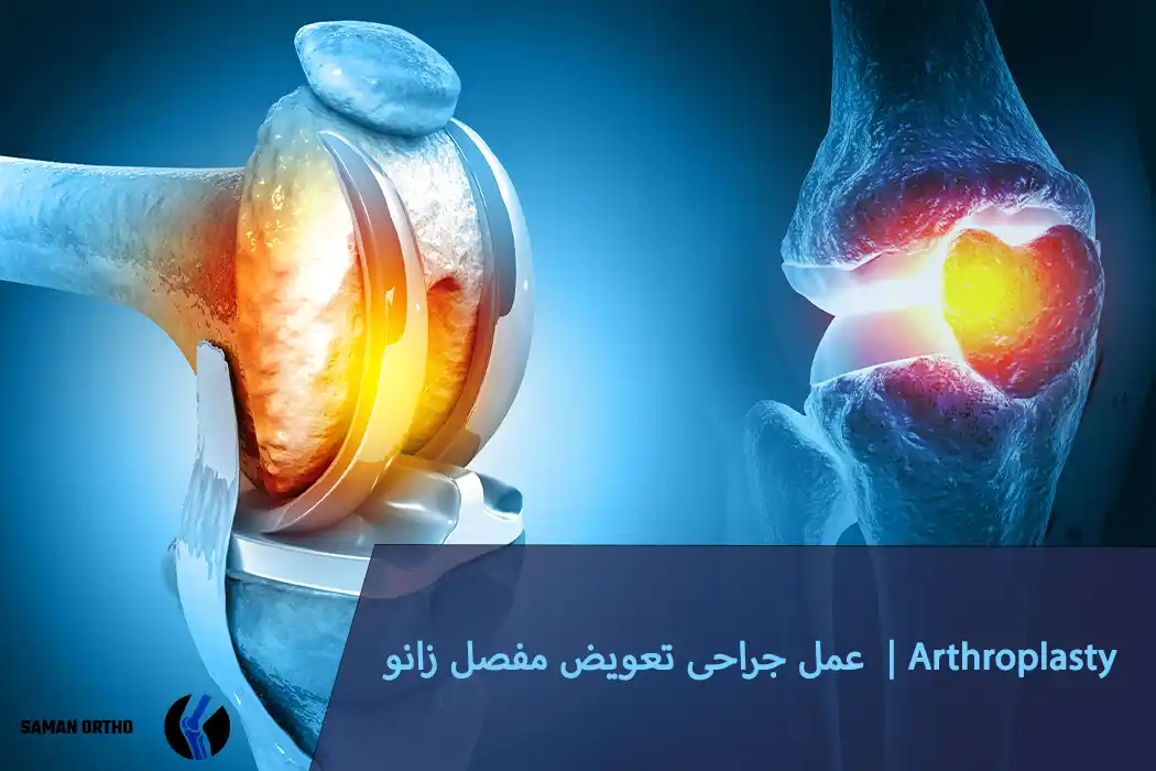 عمل جراحی تعویض مفصل زانو | آرتروپلاستی زانو عمل جراحی تعویض زانو آرتروپلاستی