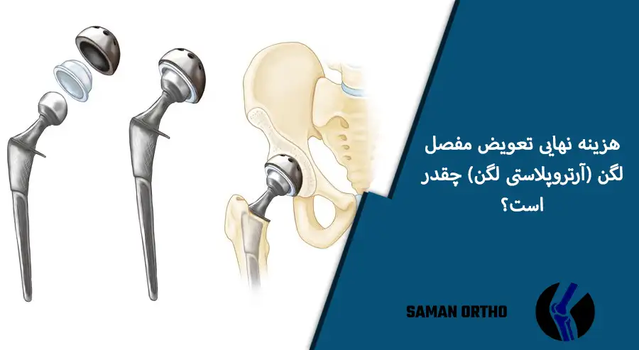 هزینه عمل جراحی تعویض مفصل لگن | راهنمای طلایی برای تصمیمگیری آگاهانه بیماران عزیز هزینه تعویض مفصل لگن