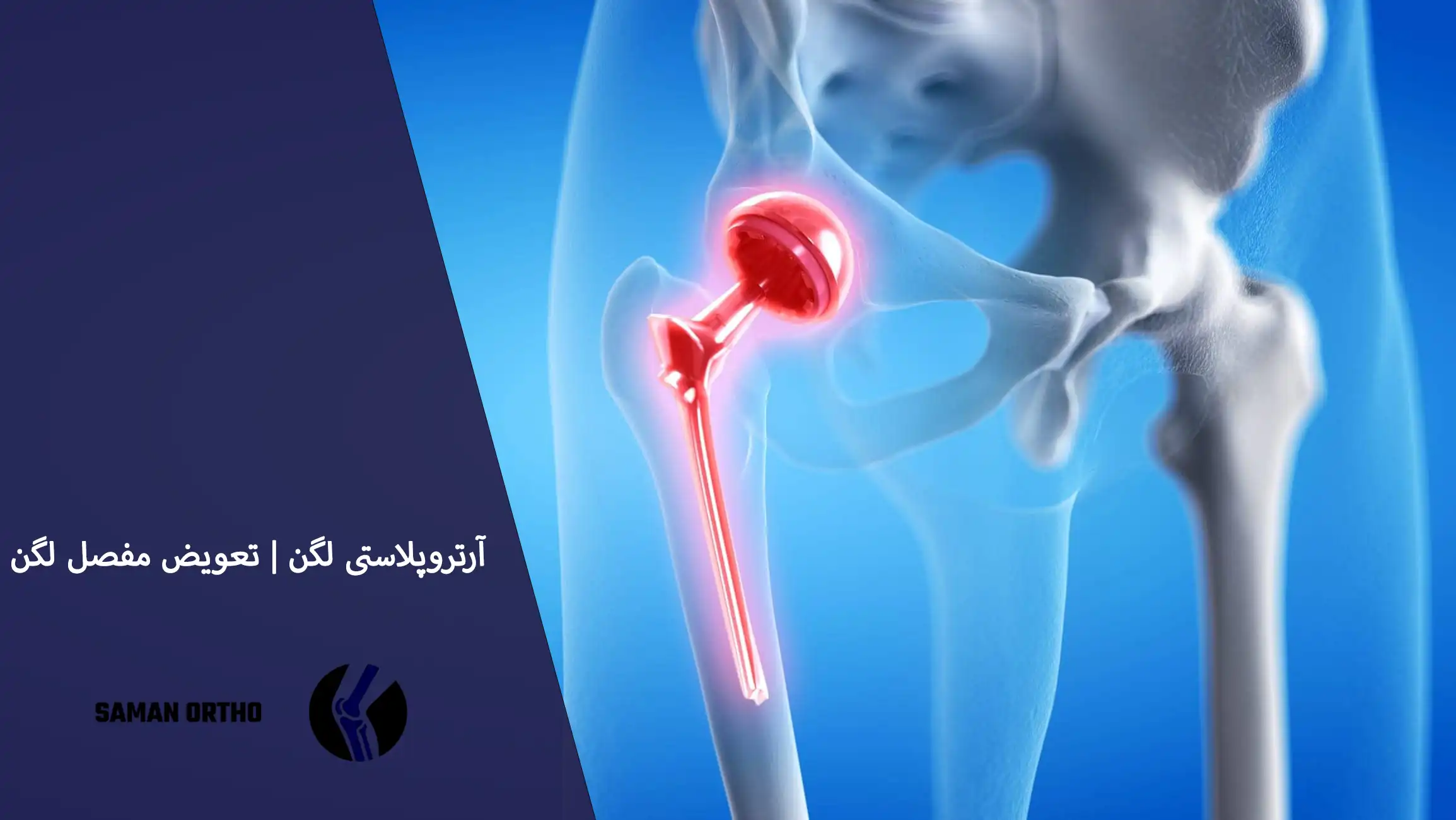 عمل آرتروپلاستی لگن یا تعویض مفصل ران برای کاهش درد و بازیابی حرکت مفصل لگ