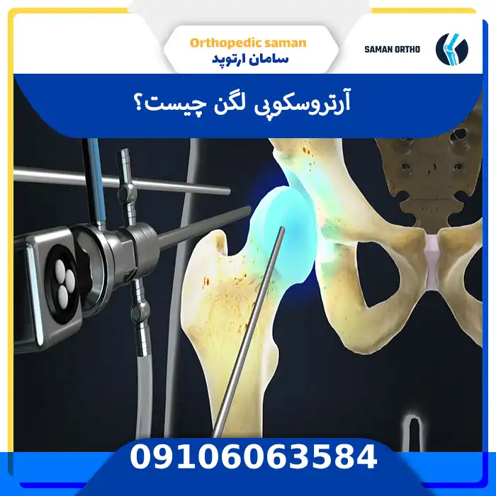 آرتروسکوپی لگن