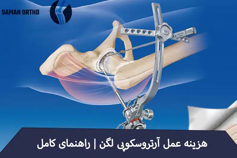 آرتروسکوپی لگن چیست؟ | راهنمای کامل و انتخابی آسان، هوشمندانه و کمخطر برای بیماران آرتروسکوپی لگن