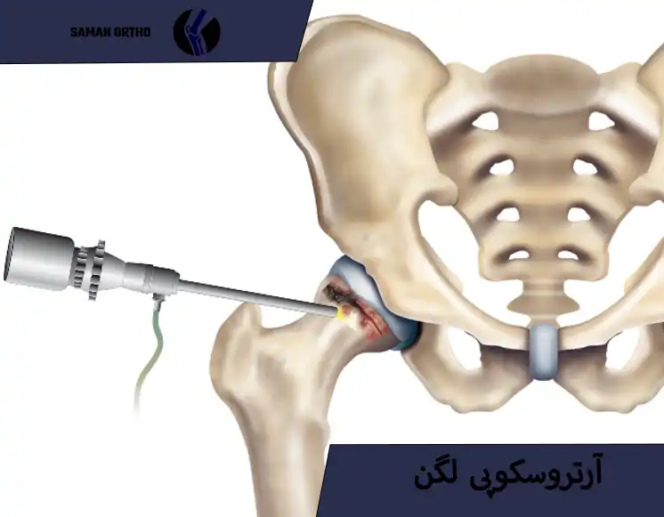 آرتروسکوپی لگن چیست؟ | راهنمای کامل و انتخابی آسان، هوشمندانه و کمخطر برای بیماران آرتروسکوپی لگن