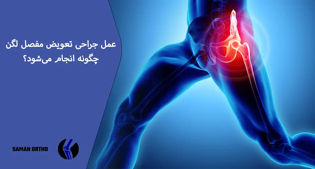عمل آرتروپلاستی لگن یا تعویض مفصل ران برای کاهش درد و بازیابی حرکت مفصل لگن 