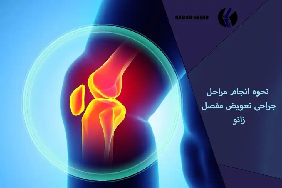 عمل جراحی تعویض مفصل زانو | آرتروپلاستی زانو عمل تعویض مفصل زانو توتال (TKA)