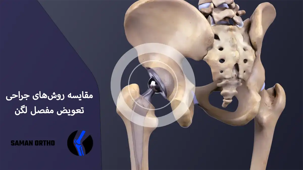 عمل آرتروپلاستی لگن یا تعویض مفصل ران برای کاهش درد و بازیابی حرکت مفصل لگن 