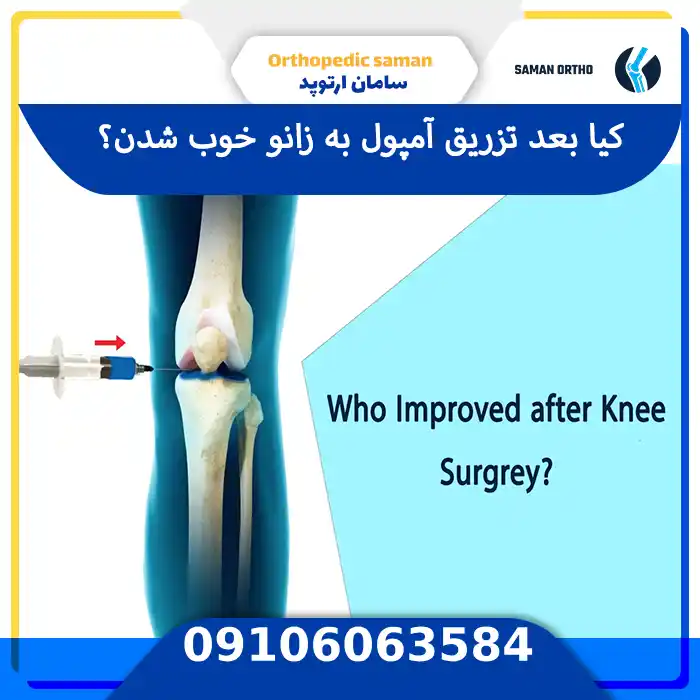 کیا بعد از تزریق آمپول زانو بهتر میشن و تجربه موفق درمان زانو