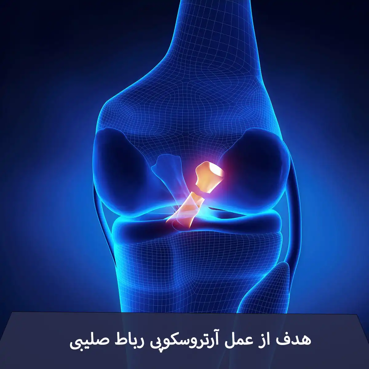 آرتروسکوپی رباط صلیبی زانو برای ترمیم پارگی ACL