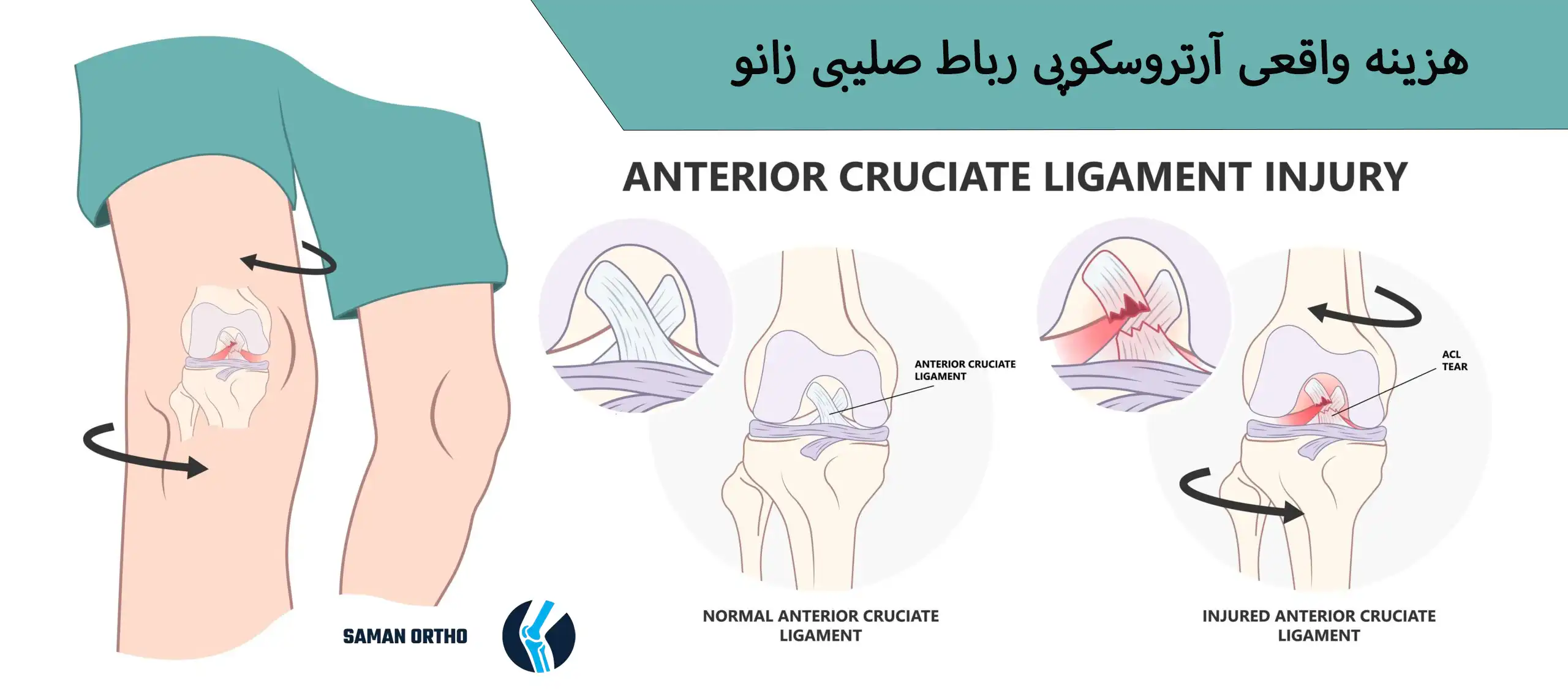 آرتروسکوپی رباط صلیبی زانو برای ترمیم پارگی ACL
