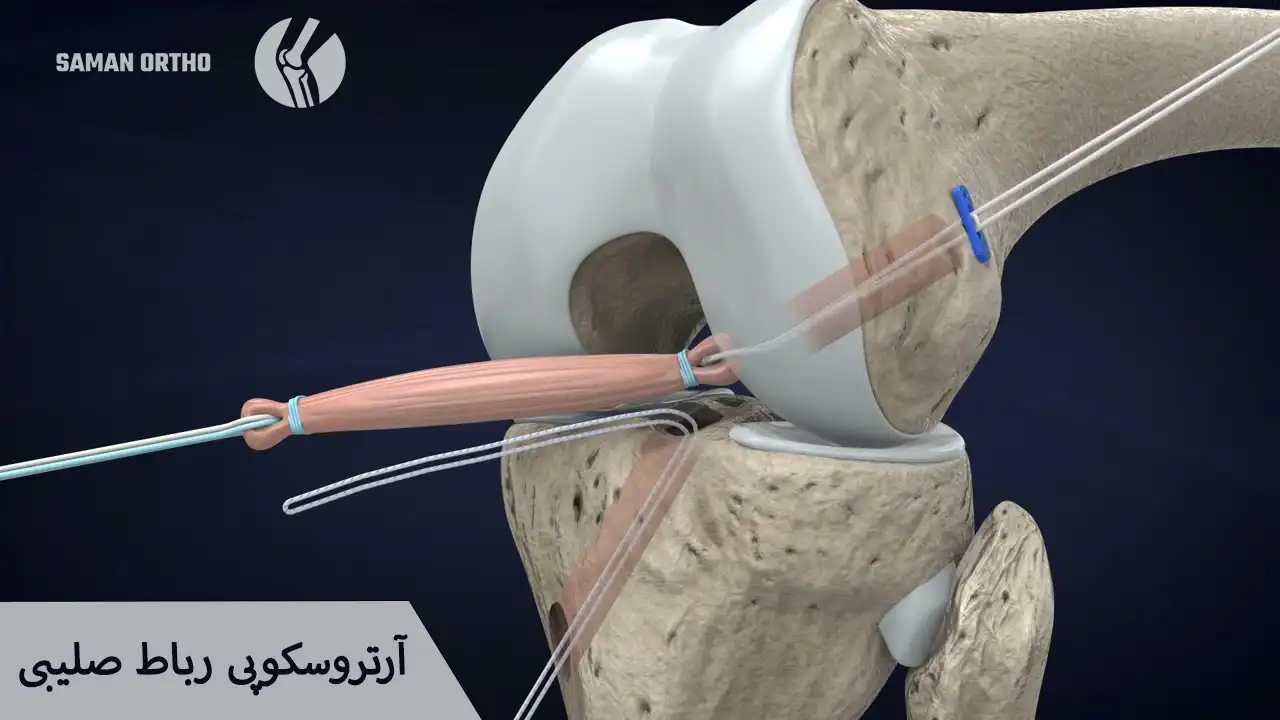 آرتروسکوپی رباط صلیبی زانو برای ترمیم پارگی ACL