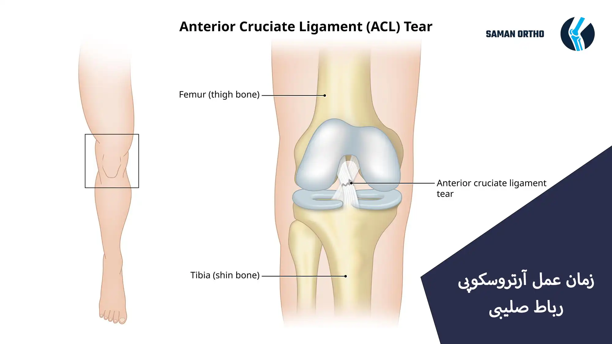 آرتروسکوپی رباط صلیبی زانو برای ترمیم پارگی ACL