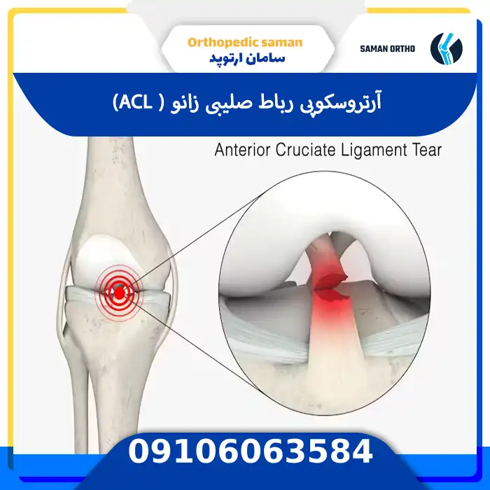 آرتروسکوپی رباط صلیبی زانو برای ترمیم پارگی ACL