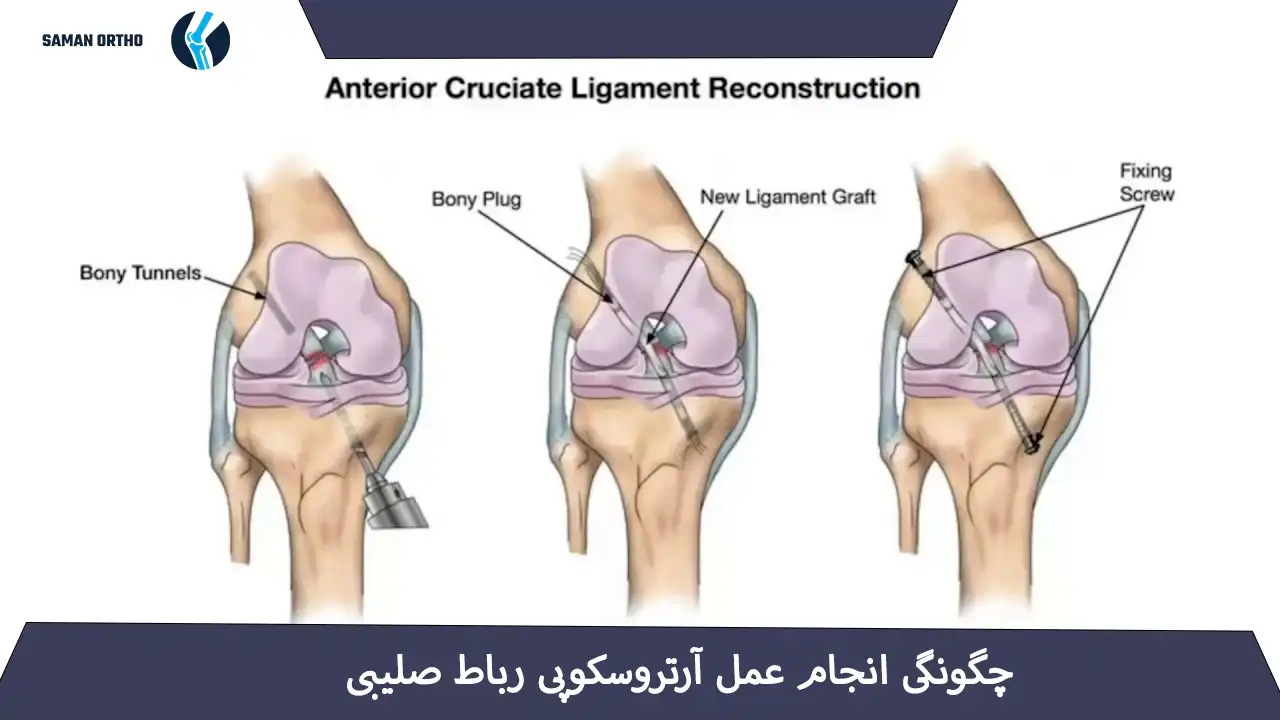 آرتروسکوپی رباط صلیبی زانو برای ترمیم پارگی ACL