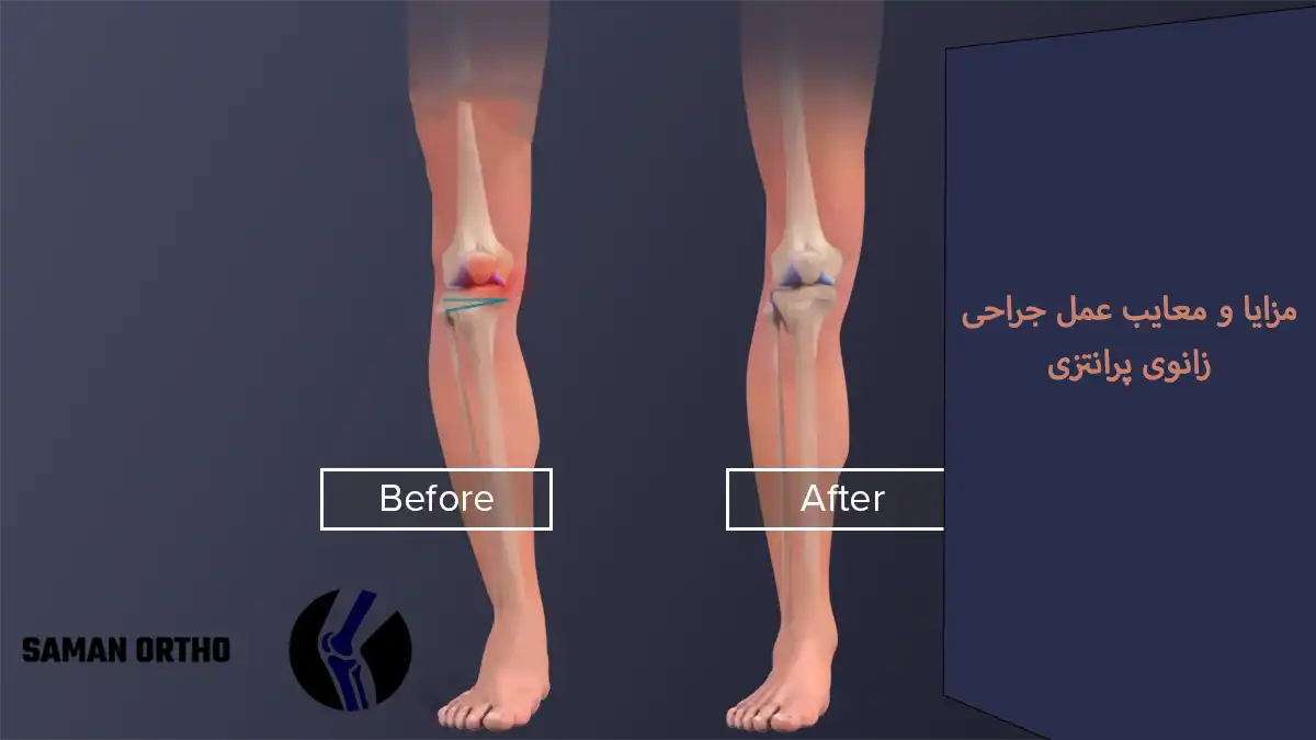 اصلاح پرانتزی پا (ژنو واروم) | بهترین روشهای عمل زانو پرانتزی برای بیماران در سال 1405 عمل جراچی پا پرانتزی