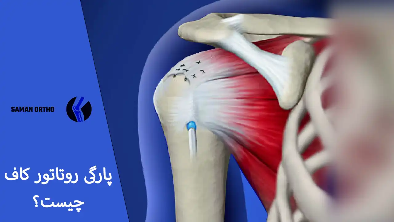 روتاتورکاف شانه و محل پارگی تاندون‌ها در مفصل شانه