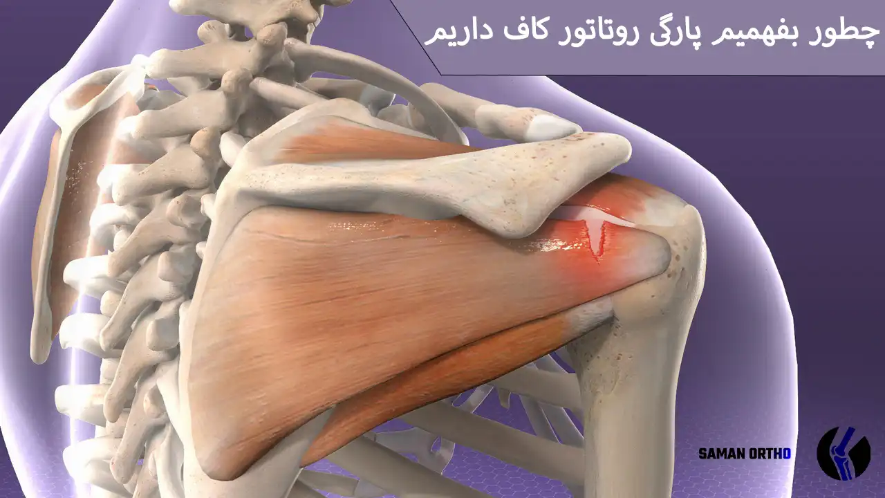 روتاتورکاف شانه و محل پارگی تاندون‌ها در مفصل شانه