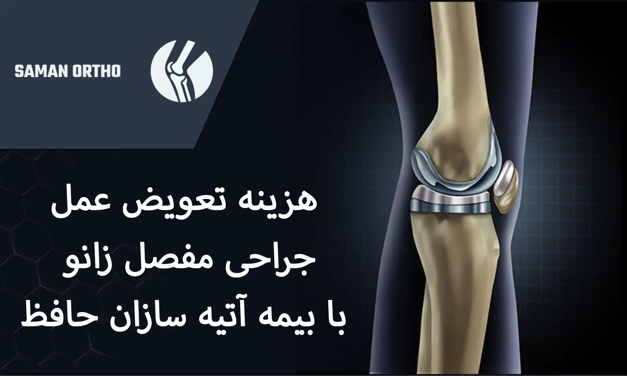 هزینه تعویض مفصل زانو با بیمه آتیه سازان حافظ | همه آنچه قبل از عمل باید بدانید! هزینه عمل تعویض مفصل زانو به کمک بیمه آتیه سازان حافظ
