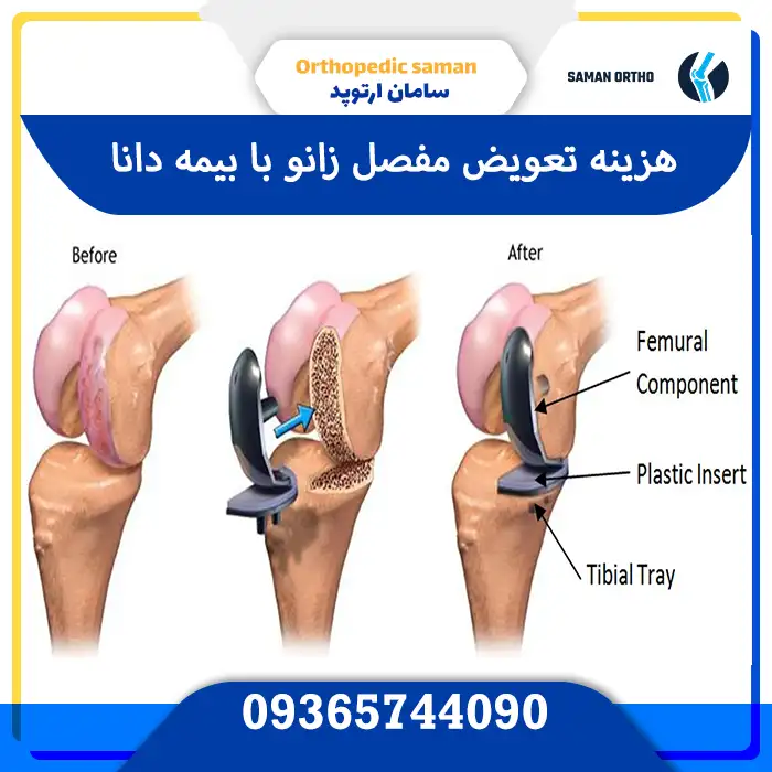 هزینه جراحی تعویض مفصل زانو | آنچه بیماران باید بدانند هزینه تعویض مفصل زانو با بیمه دانا