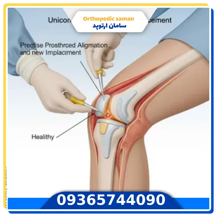 تعویض مفصل زانو با لیزر ، واقعیت پزشکی و روشهای جایگزین هزینه تعویض مفصل زانو با لیزر