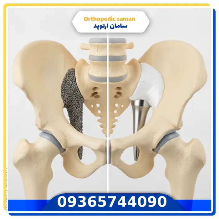آیا پروتز لگن ایرانی برای شرایط شما مناسب است؟ (معیارهای ارزیابی بالینی)