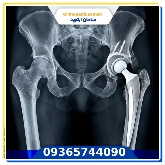 قیمت پروتز لگن زیمر در سال ۱۴۰۵